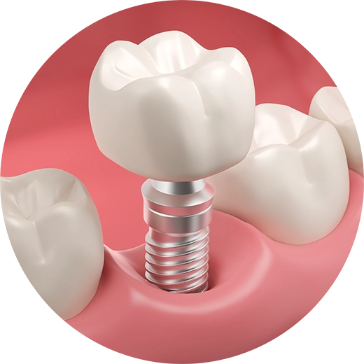 インプラントの正解を