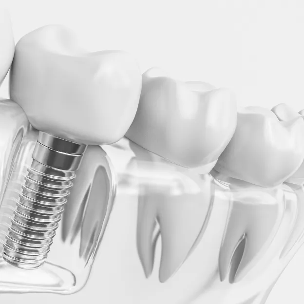 インプラント