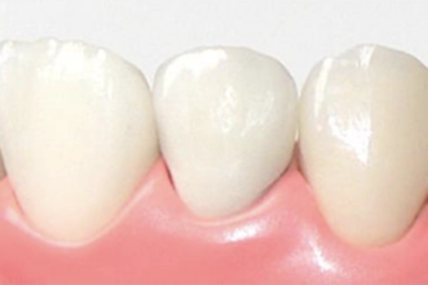 オールセラミック