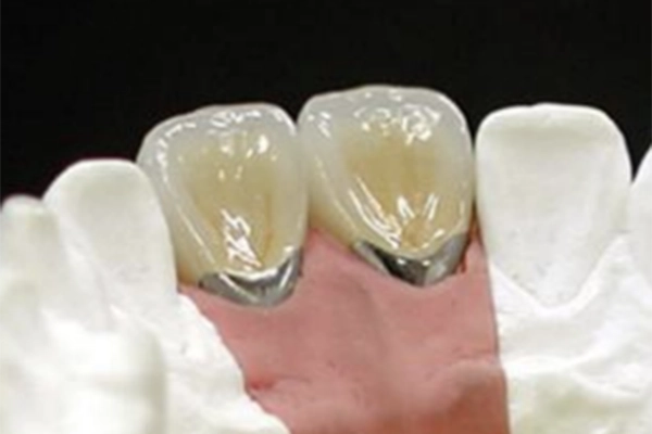 メタルセラミック