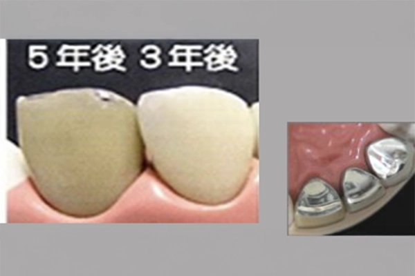 プラスチック前装冠