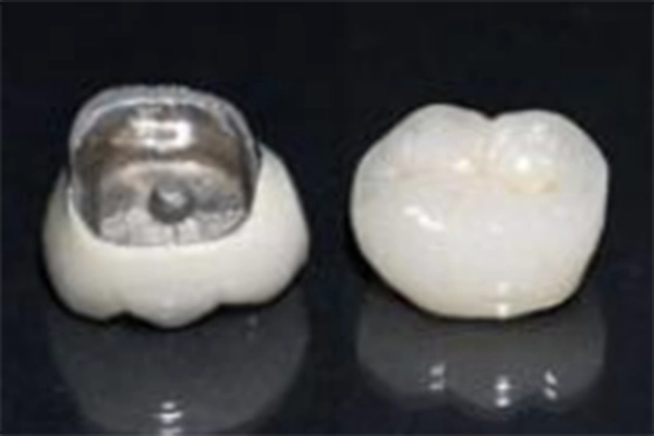 メタルセラミック