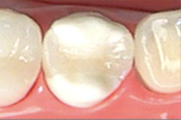 オールセラミック