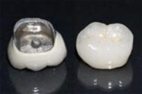 メタルセラミック