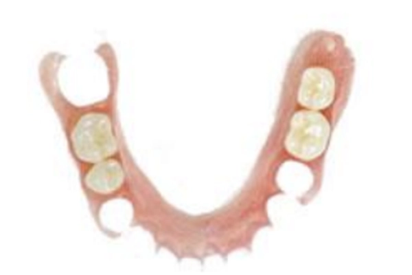 ノンクラスプ義歯