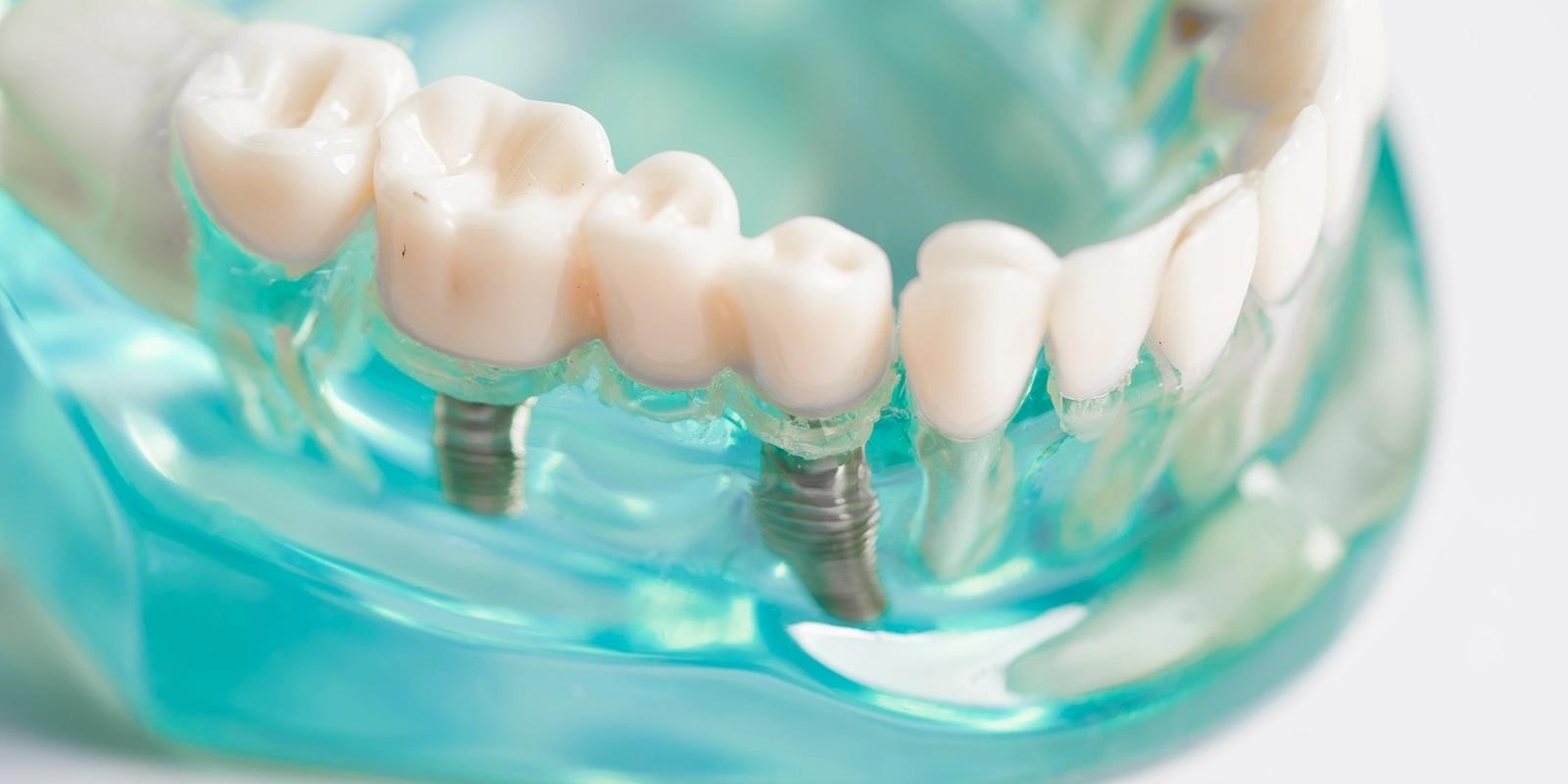 インプラントとは