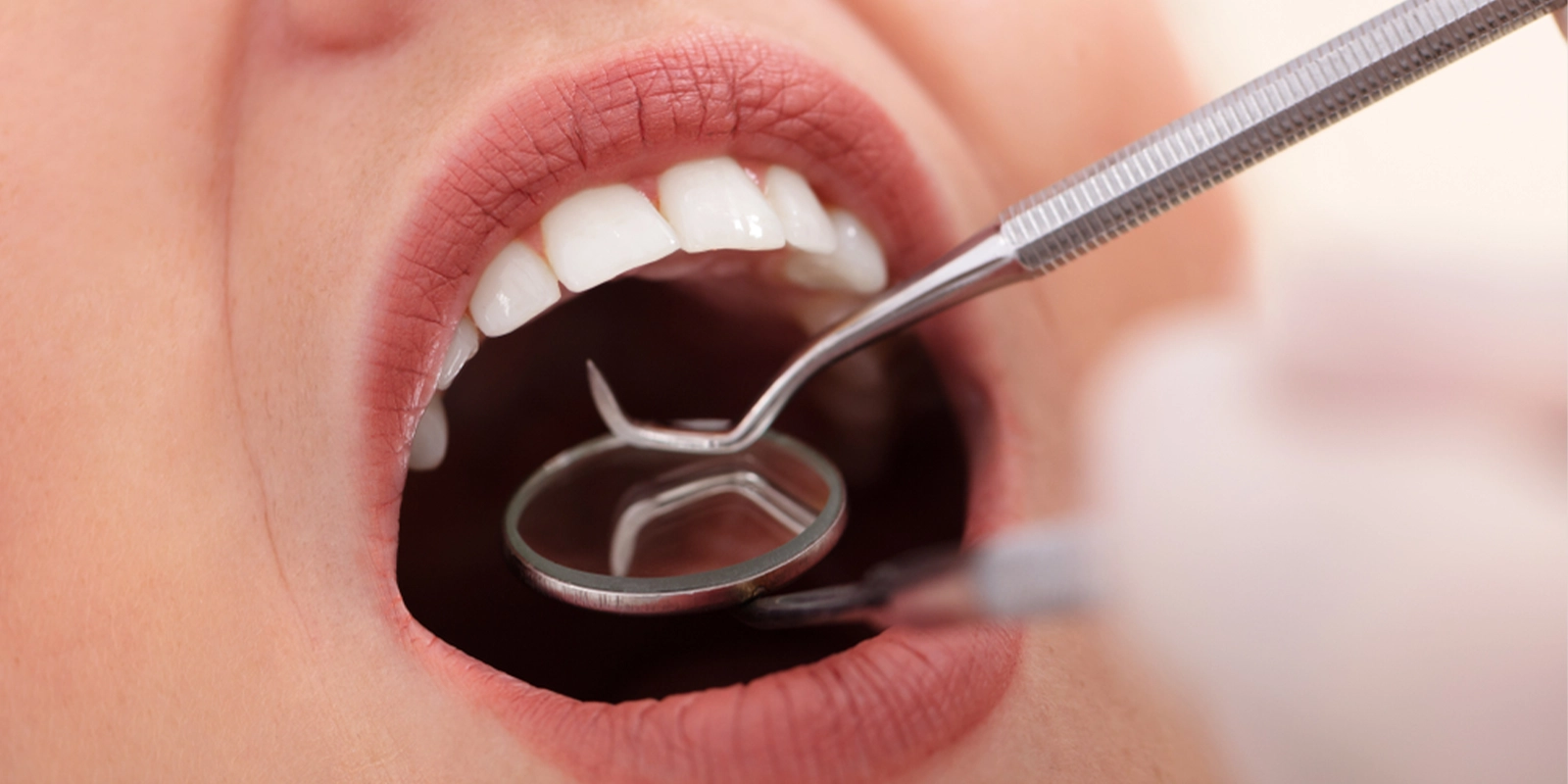 フラップレス手術