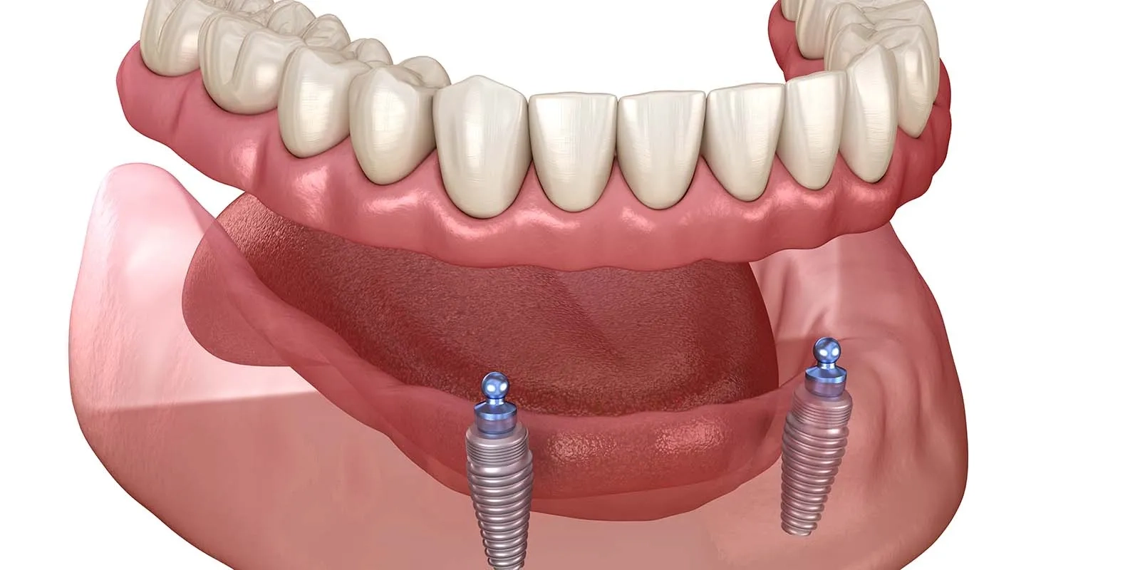 インプラントオーバーデンチャー